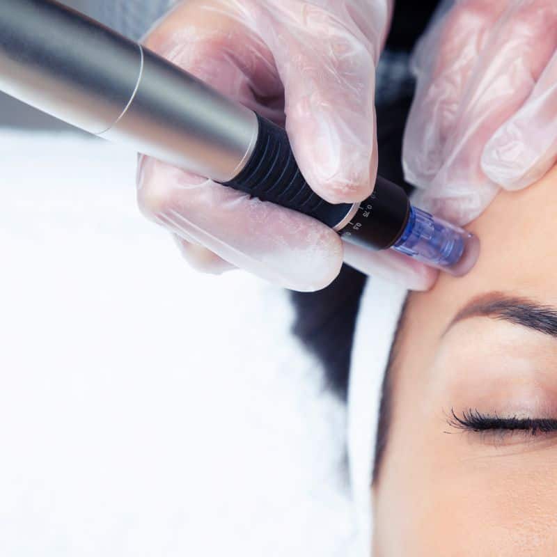 Morpheus8 treatment Eccles from Lipo Sculpt - Book in today!