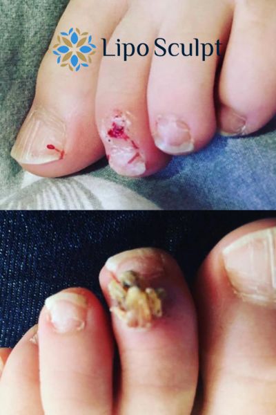 Wart removal customer results from Lipo Sculpt Eccles
